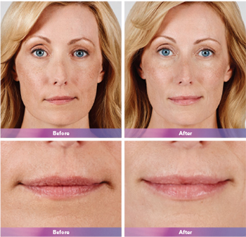 Juvederm Ultra Plus XC Before and After | skin care | Novique Medical Aesthetics | Doylestown, PA