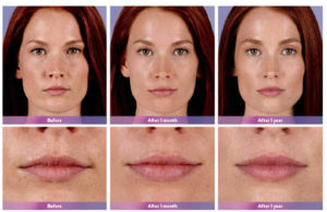 Juvederm Ultra Plus XC Before and After | skin care | Novique Medical Aesthetics | Doylestown, PA