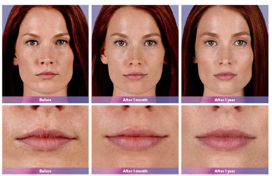 Juvederm Ultra Plus XC Before and After | skin care | Novique Medical Aesthetics | Doylestown, PA