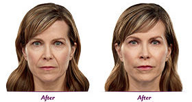 Juvederm Doylestown & Bucks County, PA Juvederm | skin care | Novique Medical Aesthetics | Doylestown, PA