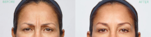 Dysport Before and After | skin care | Novique Medical Aesthetics | Doylestown, PA