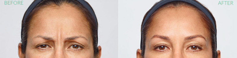 Dysport Before and After Doylestown & Bucks County, PA Dysport Before and After | skin care | Novique Medical Aesthetics | Doylestown, PA