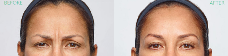 Dysport Before and After | skin care | Novique Medical Aesthetics | Doylestown, PA