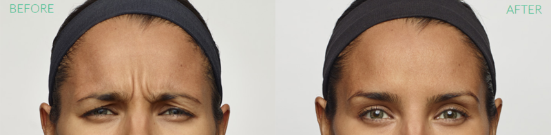 Dysport Before and After Doylestown & Bucks County, PA Dysport Before and After | skin care | Novique Medical Aesthetics | Doylestown, PA