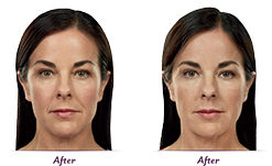 Juvederm | skin care | Novique Medical Aesthetics | Doylestown, PA