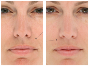 LED Light Therapy Before and After | skin care | Novique Medical Aesthetics | Doylestown, PA