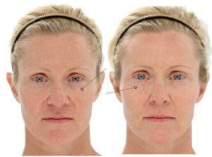 LED Light Therapy Before and After | skin care | Novique Medical Aesthetics | Doylestown, PA