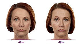 Juvederm Doylestown & Bucks County, PA Juvederm | skin care | Novique Medical Aesthetics | Doylestown, PA