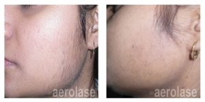 Aerolase Before and After | skin care | Novique Medical Aesthetics | Doylestown, PA