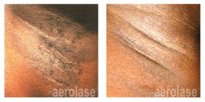 Aerolase Before and After | skin care | Novique Medical Aesthetics | Doylestown, PA