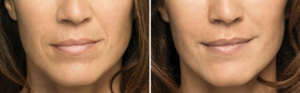 Belotero Before and After | skin care | Novique Medical Aesthetics | Doylestown, PA