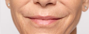 Restylane Silk | skin care | Novique Medical Aesthetics | Doylestown, PA