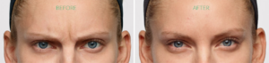 Dysport Before and After | skin care | Novique Medical Aesthetics | Doylestown, PA