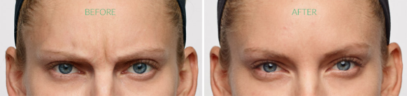 Dysport Before and After Doylestown & Bucks County, PA Dysport Before and After | skin care | Novique Medical Aesthetics | Doylestown, PA