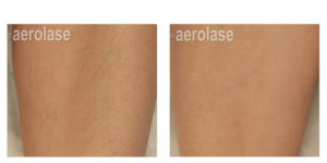 Laser Hair Removal Before and After | skin care | Novique Medical Aesthetics | Doylestown, PA