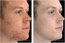Before and After Juvederm | skin care | Novique Medical Aesthetics | Doylestown, PA