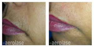 Aerolase Before and After | skin care | Novique Medical Aesthetics | Doylestown, PA