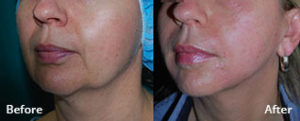 RF Microneedling | skin care | Novique Medical Aesthetics | Doylestown, PA