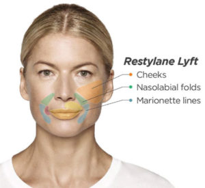 Restylane Lyft Treatment | skin care | Novique Medical Aesthetics | Doylestown, PA