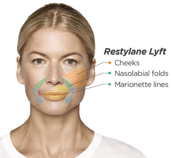 Restylane Lyft Treatment | skin care | Novique Medical Aesthetics | Doylestown, PA