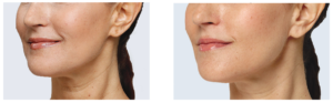 Restylane Lyft Before & After | skin care | Novique Medical Aesthetics | Doylestown, PA