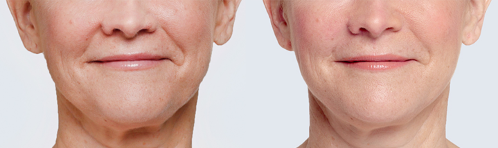 Restylane Lyft Before & After | skin care | Novique Medical Aesthetics | Doylestown, PA