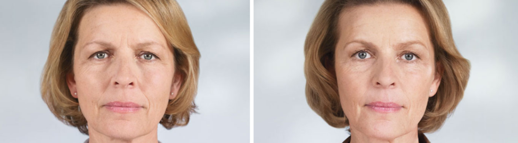 Sculptra Before and After | skin care | Novique Medical Aesthetics | Doylestown, PA