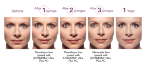 Juvederm | skin care | Novique Medical Aesthetics | Doylestown, PA