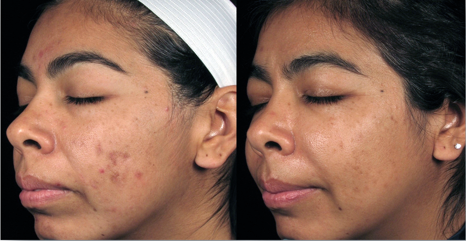 Dermalinfusion Before & After | skin care | Novique Medical Aesthetics | Doylestown, PA