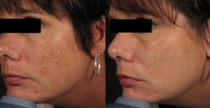 Dermalinfusion Before & After | skin care | Novique Medical Aesthetics | Doylestown, PA