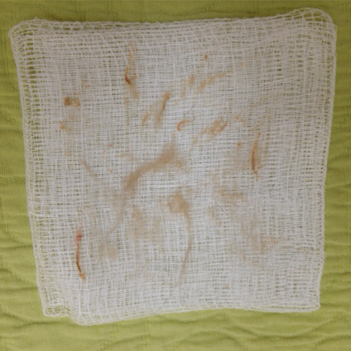 Dermaplaning Doylestown PA Dermaplaning Treatment | skin care | Novique Medical Aesthetics | Doylestown, PA