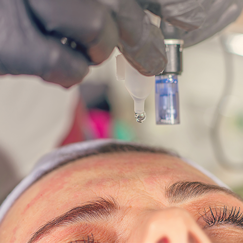Microneedling Doylestown, PA Microneedling | skin care | Novique Medical Aesthetics | Doylestown, PA