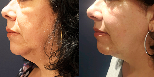 RF Microneedling Doylestown, PA RF Microneedling | skin care | Novique Medical Aesthetics | Doylestown, PA
