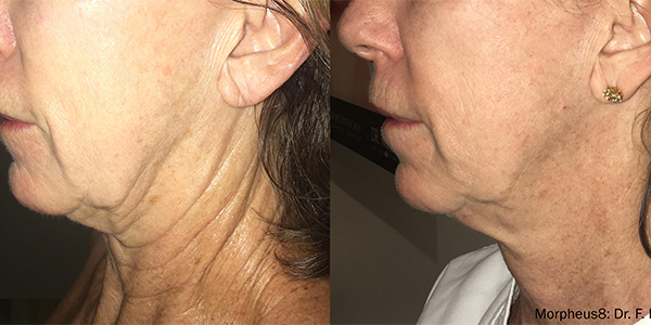 RF Microneedling Doylestown, PA RF Microneedling | skin care | Novique Medical Aesthetics | Doylestown, PA