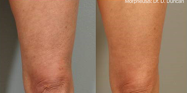 RF Microneedling Doylestown, PA RF Microneedling | skin care | Novique Medical Aesthetics | Doylestown, PA