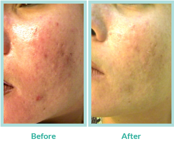 Salt Facial Before & After | skin care | Novique Medical Aesthetics | Doylestown, PA