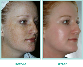 Salt Facial Before & After | skin care | Novique Medical Aesthetics | Doylestown, PA