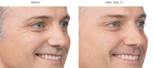 Brotox (Botox For Men) | skin care | Novique Medical Aesthetics | Doylestown, PA