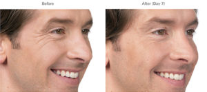 Brotox (Botox For Men) | skin care | Novique Medical Aesthetics | Doylestown, PA