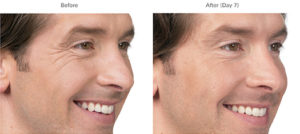 Brotox (Botox For Men) Doylestown, PA Brotox (Botox For Men) | skin care | Novique Medical Aesthetics | Doylestown, PA