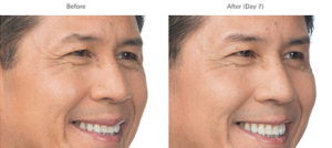 Brotox (Botox For Men) | skin care | Novique Medical Aesthetics | Doylestown, PA