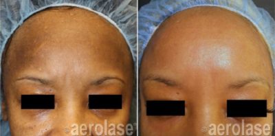 Aerolase Before and After | skin care | Novique Medical Aesthetics | Doylestown, PA