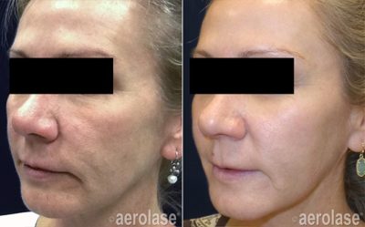 Aerolase Before and After | skin care | Novique Medical Aesthetics | Doylestown, PA