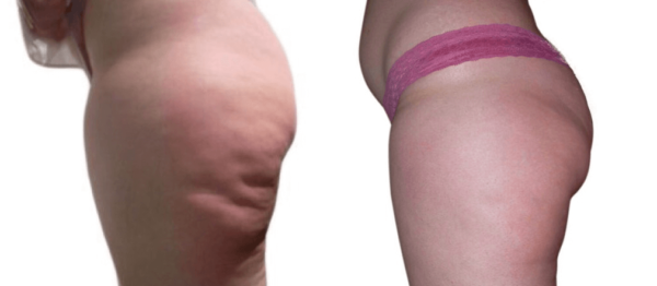 Venus Legacy Doylestown Venus Legacy | skin care | Novique Medical Aesthetics | Doylestown, PA