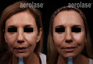 Aerolase Before and After | skin care | Novique Medical Aesthetics | Doylestown, PA