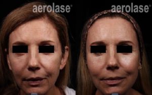 Aerolase Before and After | skin care | Novique Medical Aesthetics | Doylestown, PA