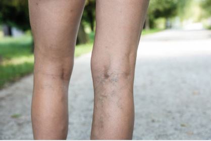 Sclerotherapy | skin care | Novique Medical Aesthetics | Doylestown, PA