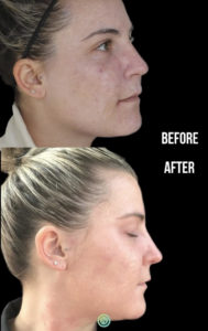 The Enlighten™ RX AT HOME or OFFICE Peel before after | skin care | Novique Medical Aesthetics | Doylestown, PA