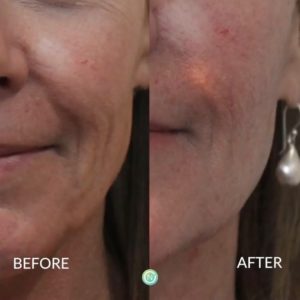 Botox filler treatment before and after | skin care | Novique Medical Aesthetics | Doylestown, PA