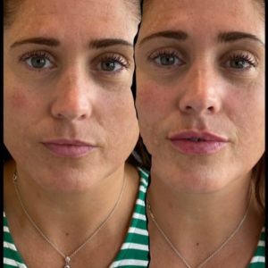 botox filler before and after treatment | skin care | Novique Medical Aesthetics | Doylestown, PA